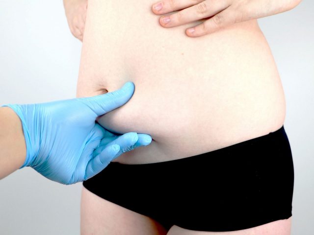 Abdominoplastie sur Nice : la solution pour ma surcharge graisseuse