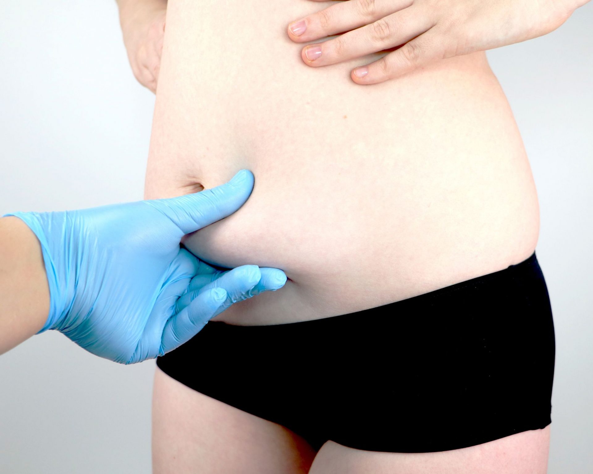 Abdominoplastie sur Nice : la solution pour ma surcharge graisseuse