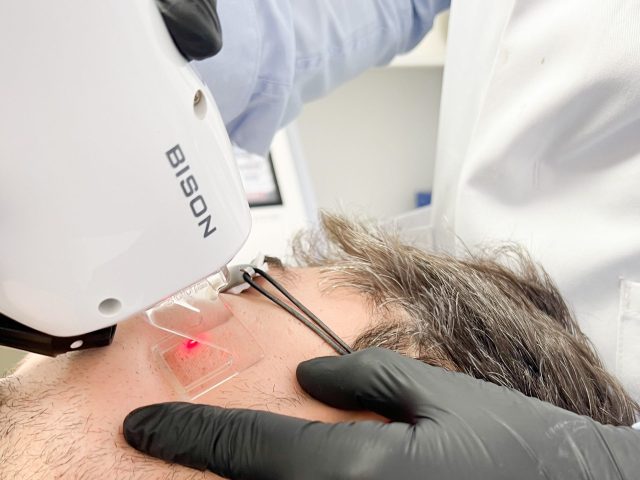 J’ai réalisé un traitement au laser pour mes cicatrices d’acné