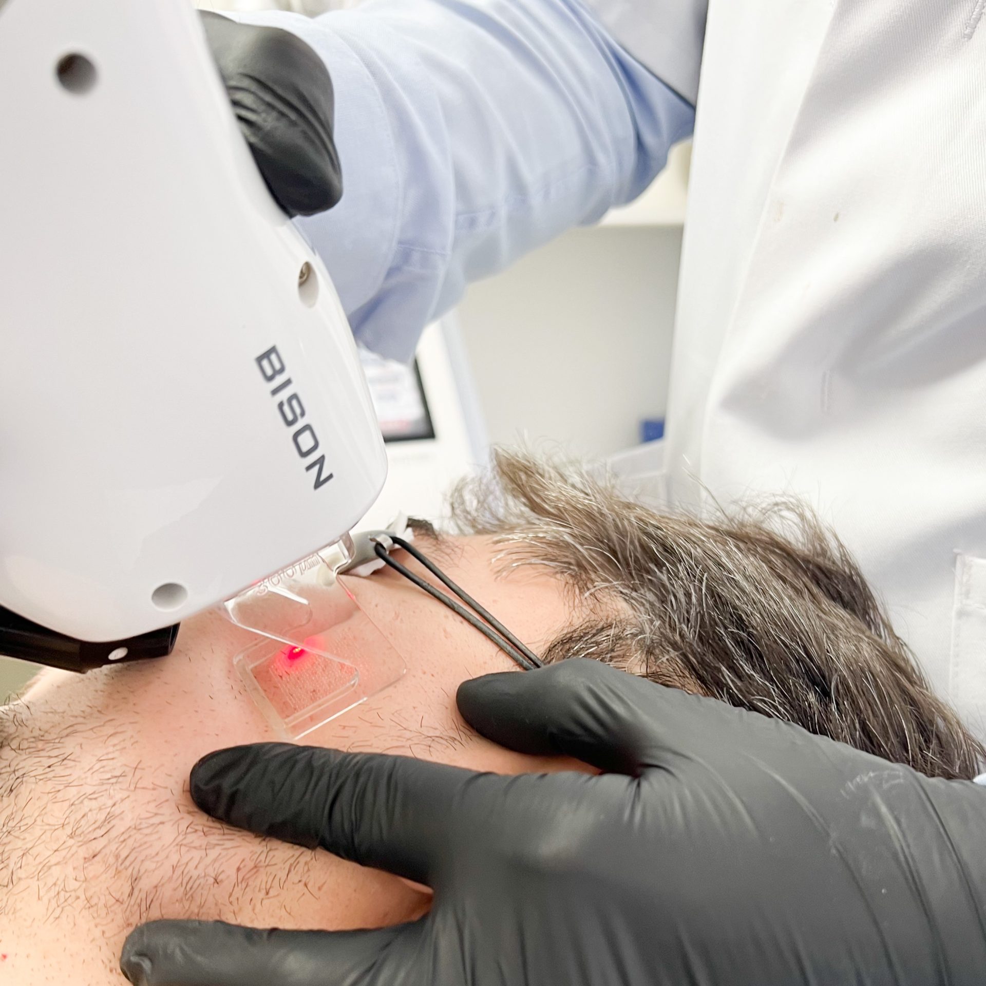 Le traitement au laser est une solution idéale pour vos cicatrices d'acné !